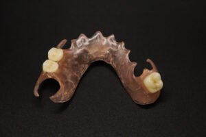 Implant restoration